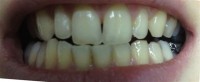 Izbjeljivanje zuba-prije 2